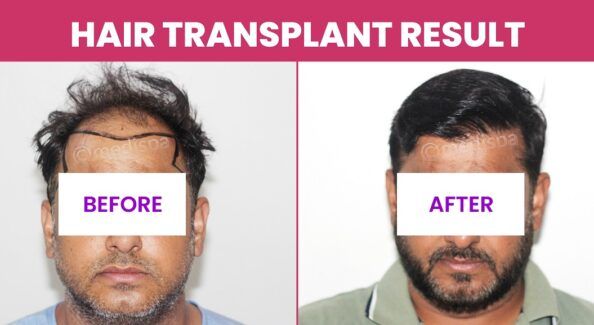 What To Know Before Undergoing Body Hair Transplant?
