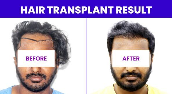 How To Get The Ideal Hair Density With Hair Transplantation?
