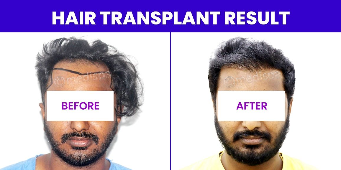 How To Get The Ideal Hair Density With Hair Transplantation?