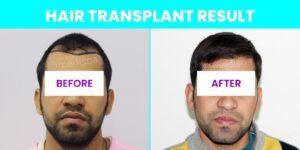Rediscover Your Confidence With Hair Transplant