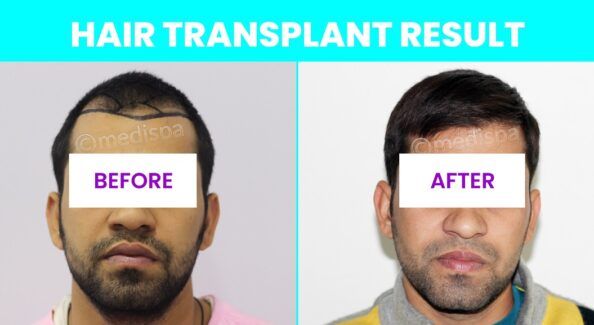 Rediscover Your Confidence With Hair Transplant