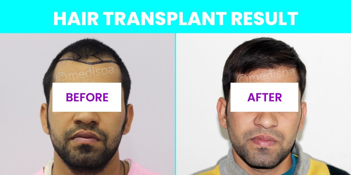 Rediscover Your Confidence With Hair Transplant