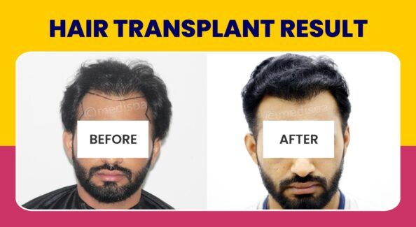 Is Hair Restoration The Most Effective Hair Loss Treatment?