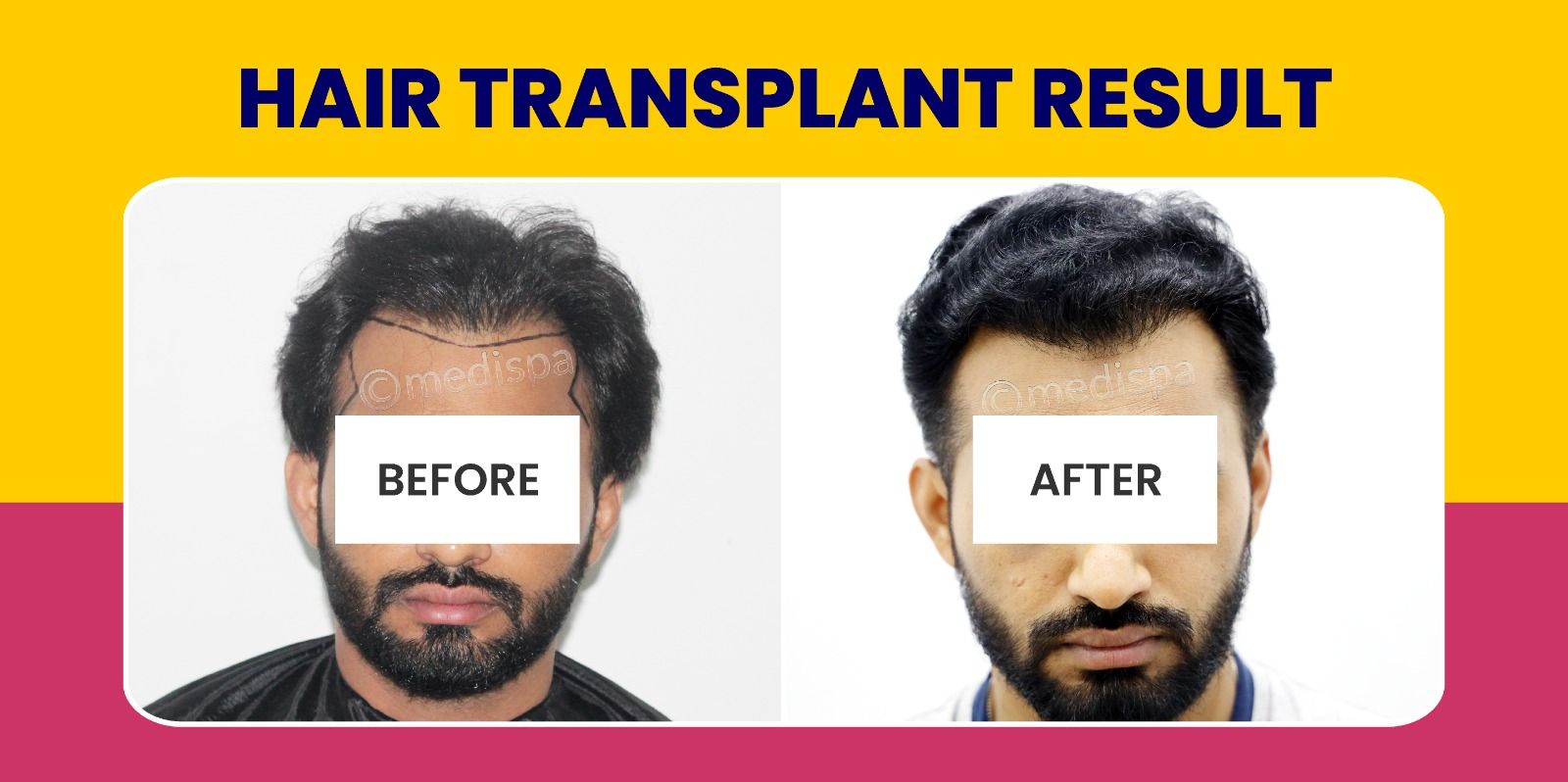 Is Hair Restoration The Most Effective Hair Loss Treatment?