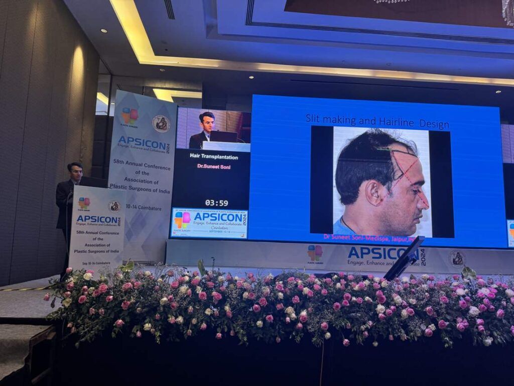 hair transplant cost delhi