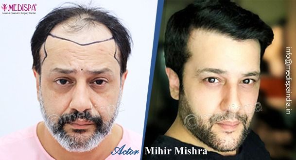 hair transplant in india