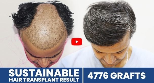 hair transplant videos