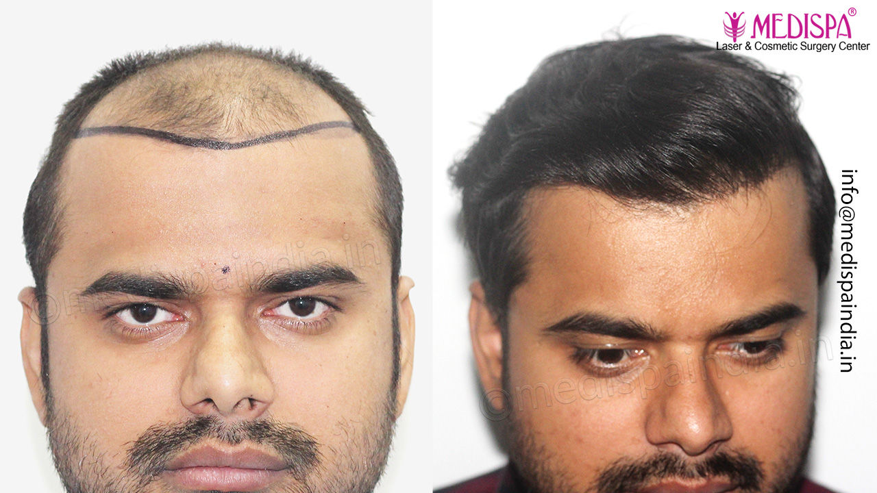 hair transplant india