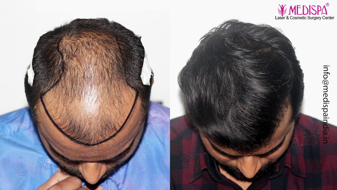 1 year hair transplant results