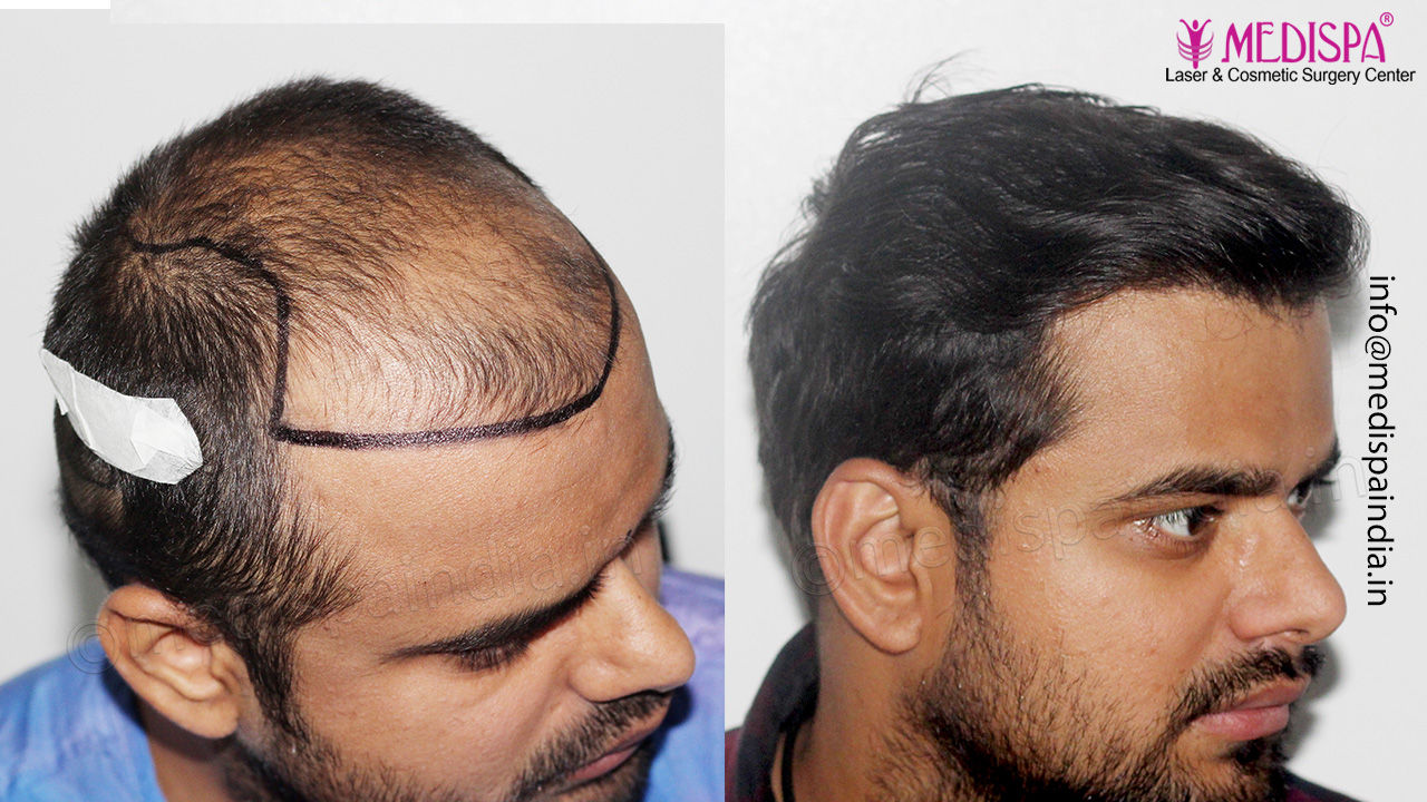 12 month hair transplant results