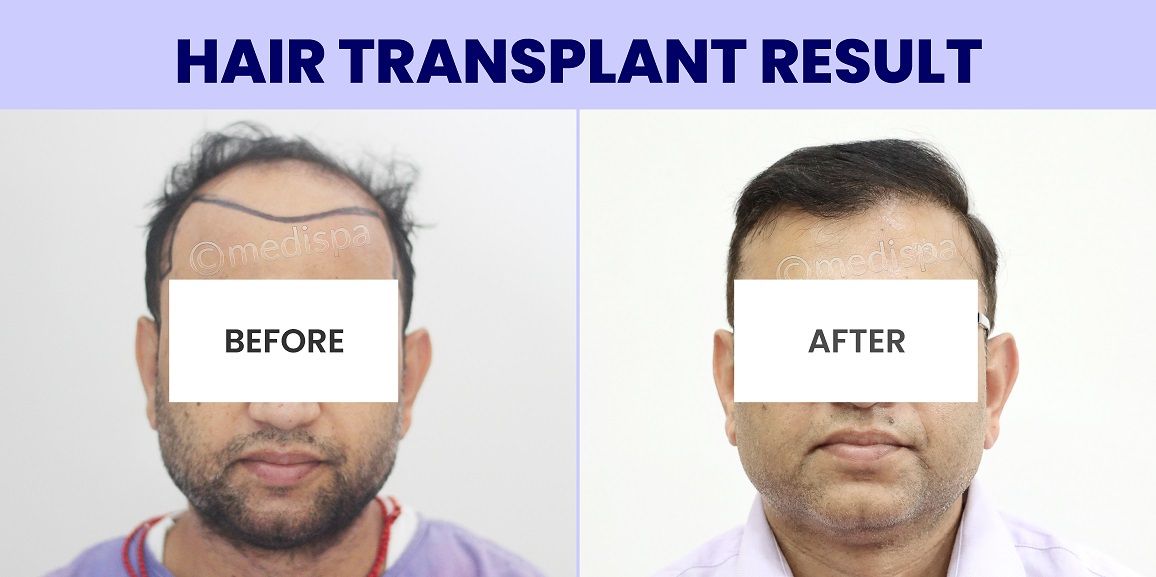 How To Find The Best Clinic For Wrong Hair Transplant Correction?
