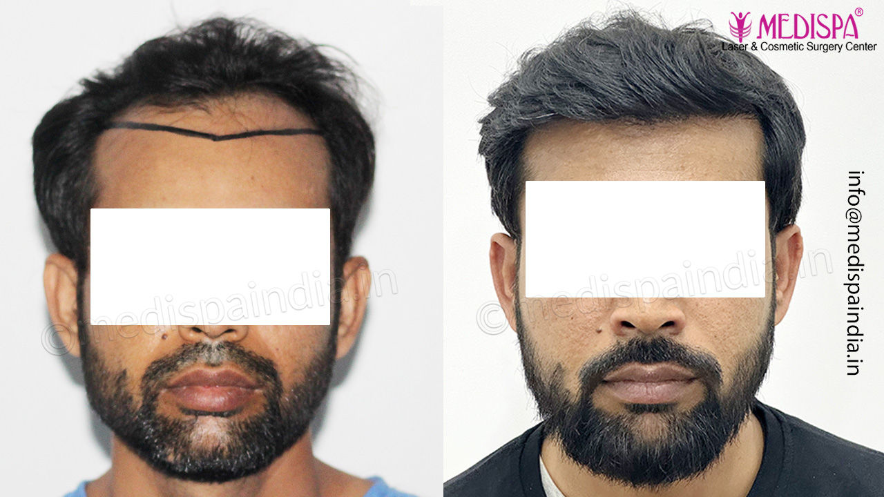 hair transplant cost in India