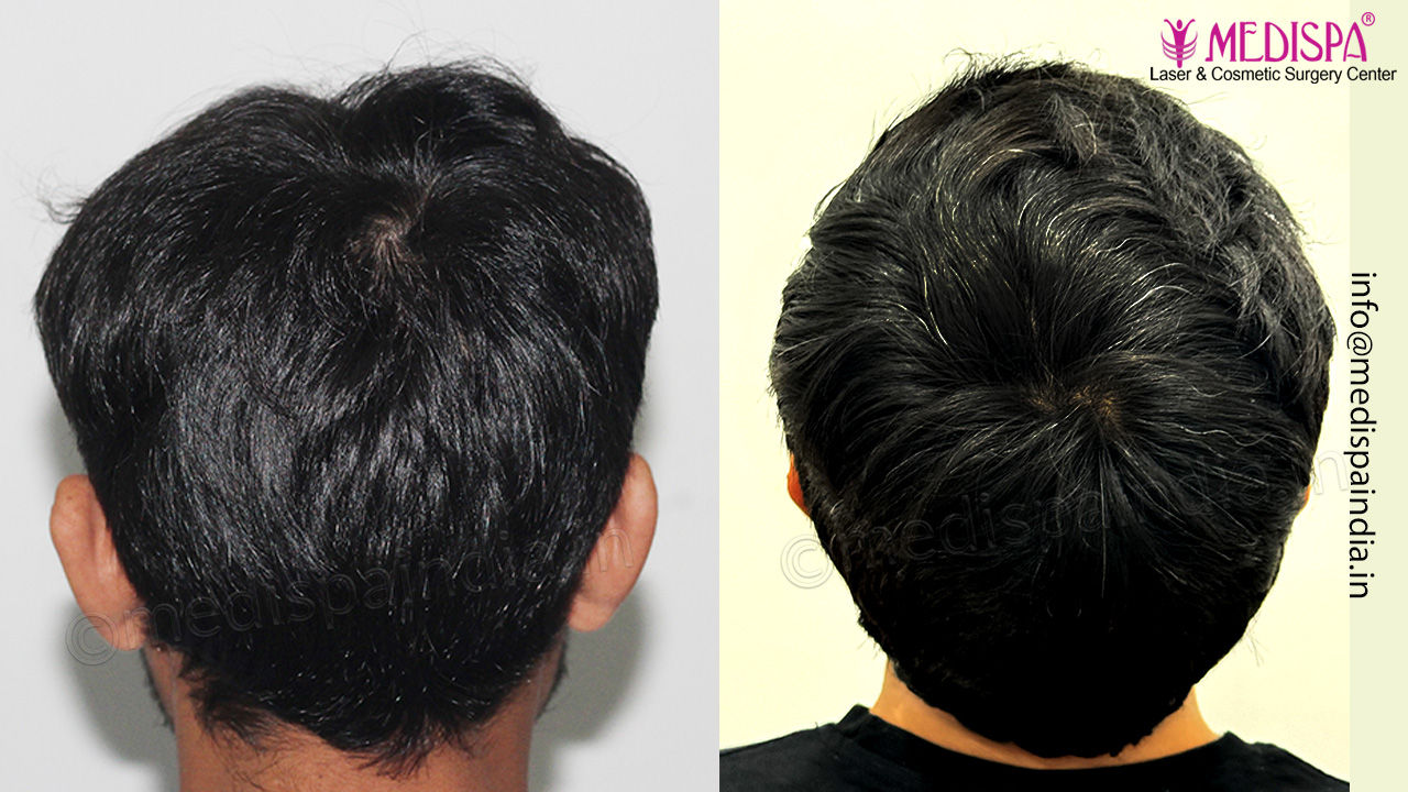 Fue hair transplant result
