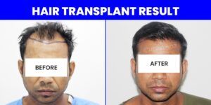 Facts You Must Know About Male Hair Transplant
