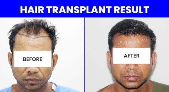 Facts You Must Know About Male Hair Transplant