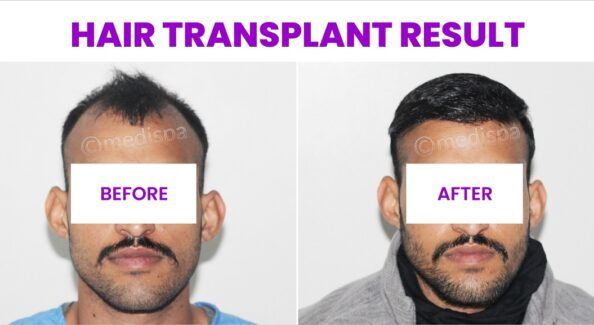 Hair Restoration: Permanent And Long-Lasting Hair Growth Solution