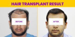 Can Hair Transplant Provide Natural Looking Permanent Results?