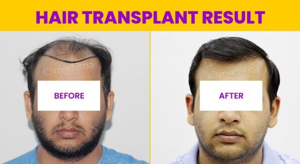 Can Hair Transplant Provide Natural Looking Permanent Results?