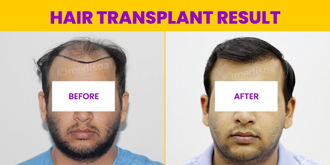Can Hair Transplant Provide Natural Looking Permanent Results?