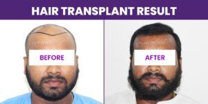 Is Hair Transplant The Best Way To Cure Pattern Baldness?