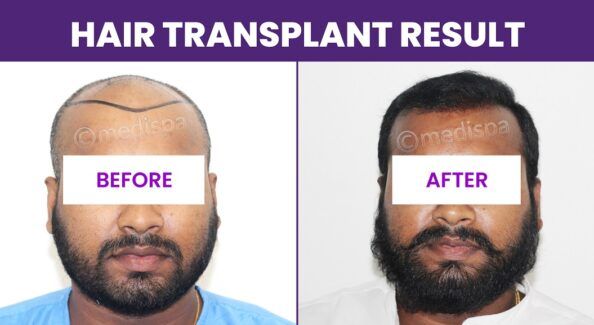 Is Hair Transplant The Best Way To Cure Pattern Baldness?