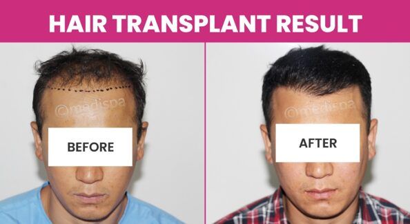 What Are The Best Ways To Get Successful Hair Transplant Results?