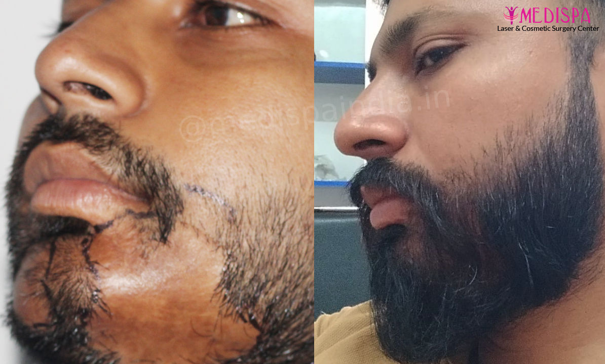 beard hair transplant delhi