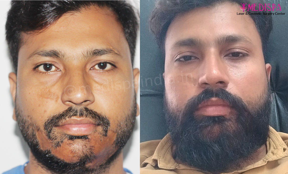 beard hair transplant india