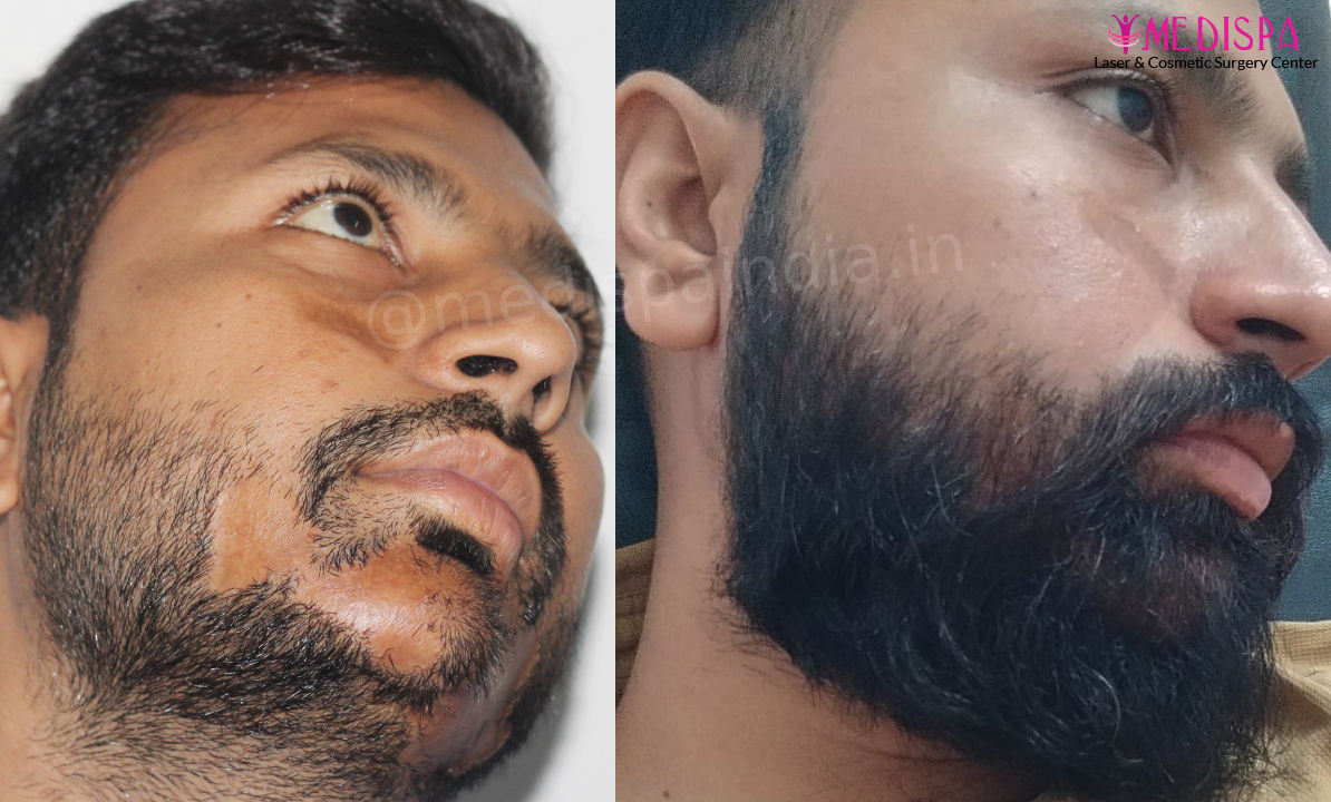 beard hair transplant jaipur