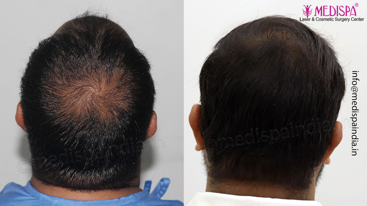 best hair restoration results india