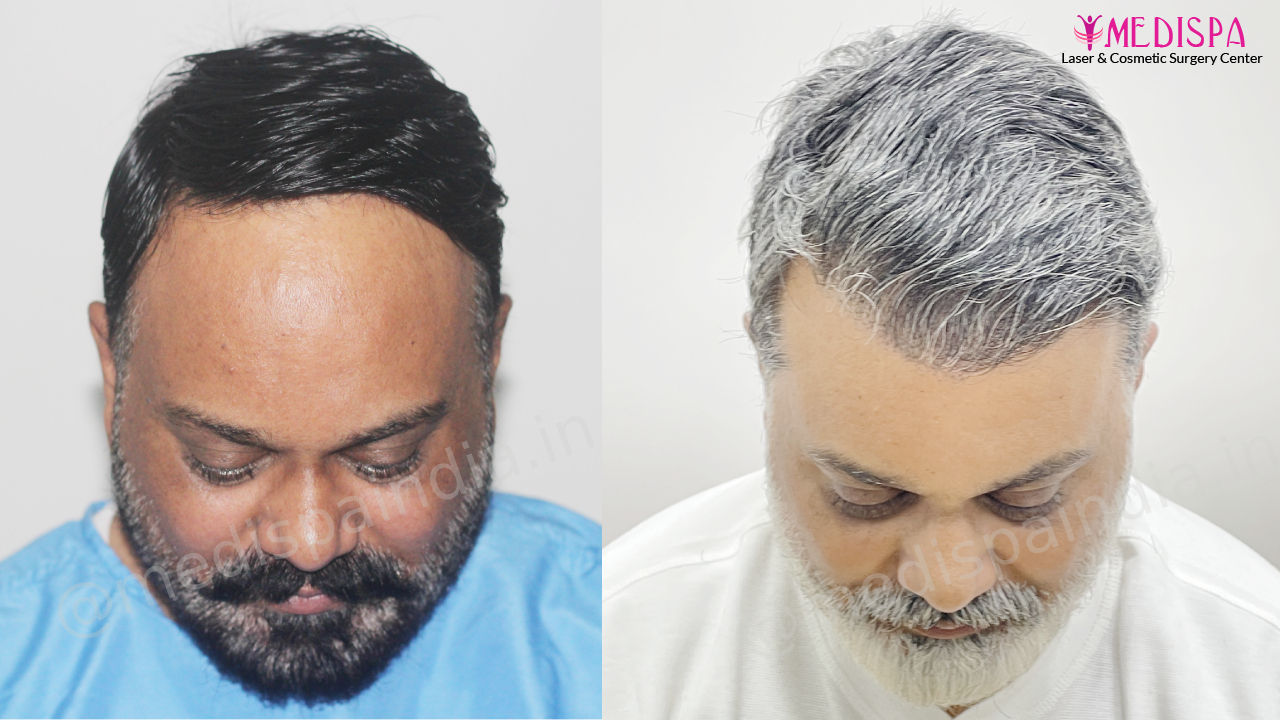 Hair Transplant in India