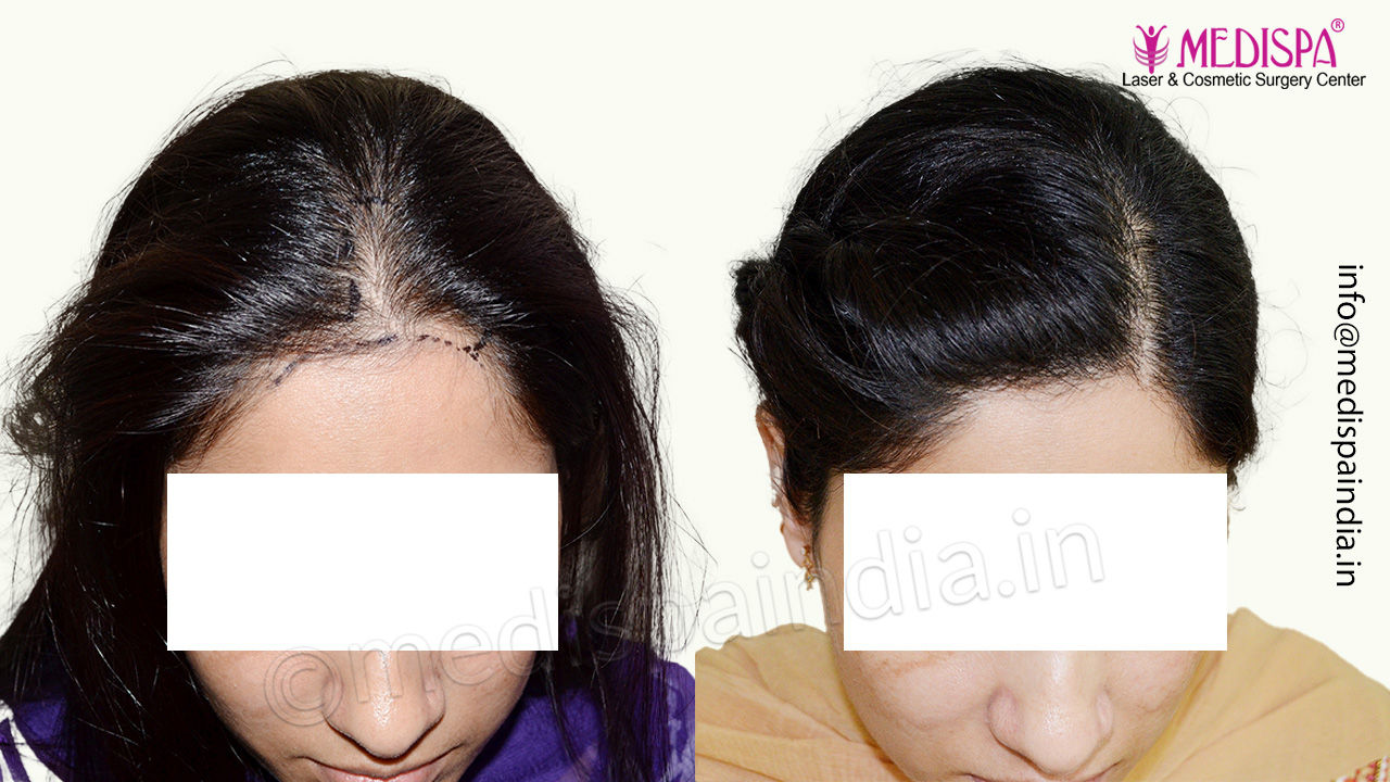 female hair transplant delhi