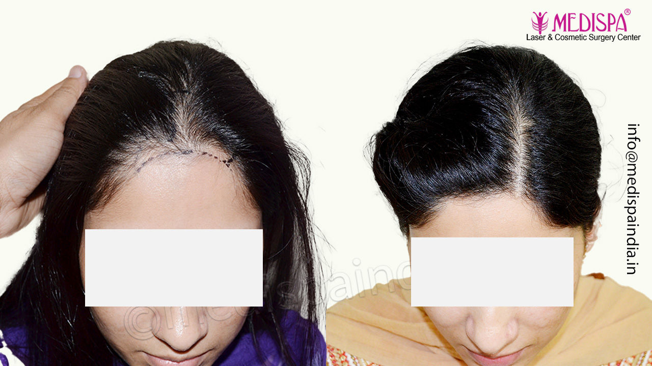 female hair transplant jaipur