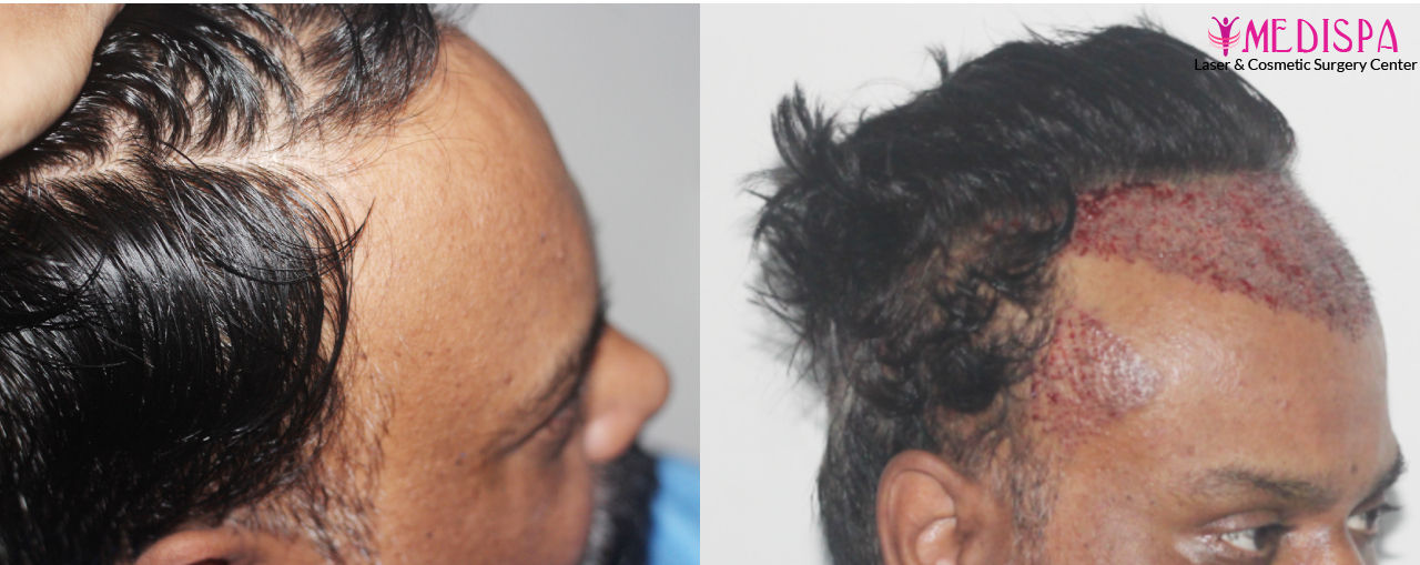 hair restoration clinic results