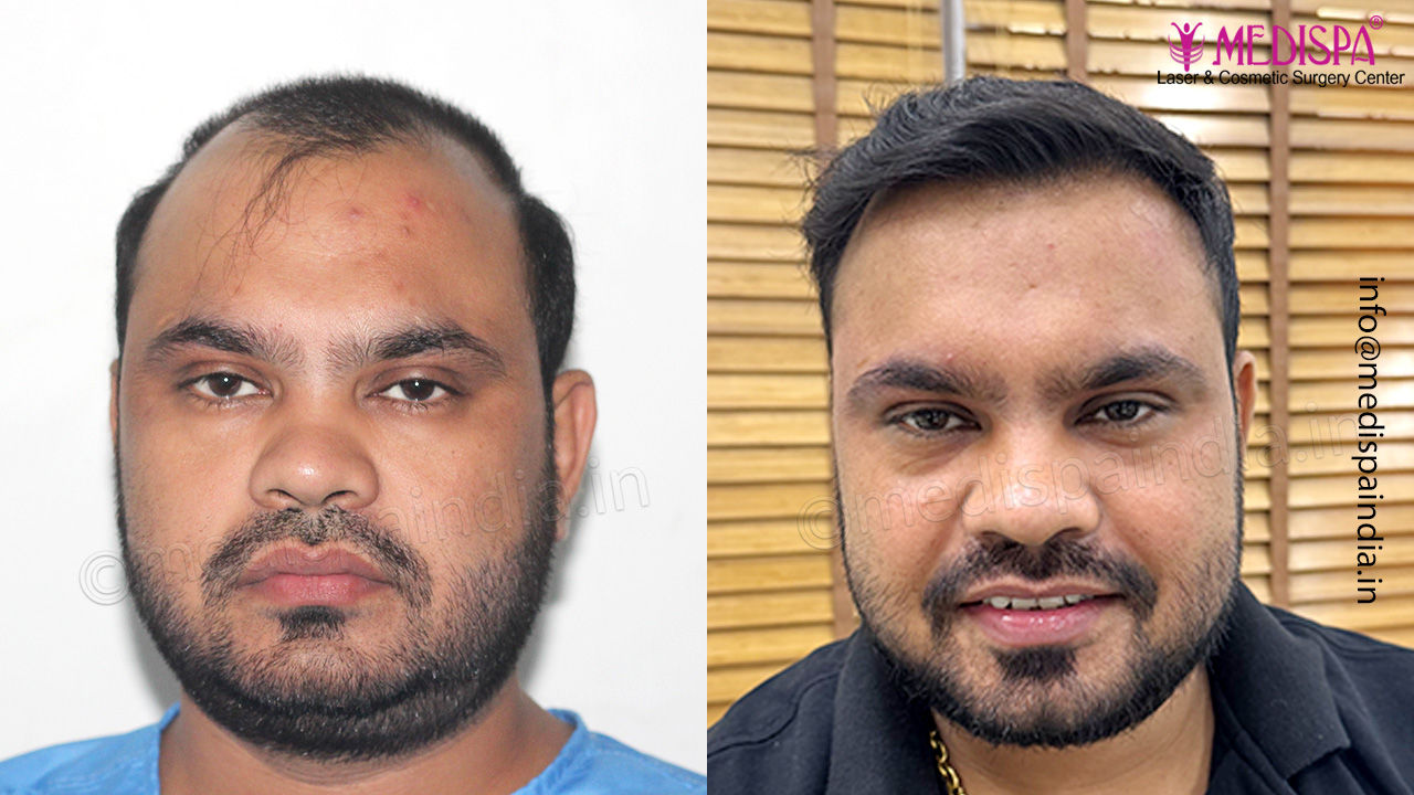 hair transplant delhi, india