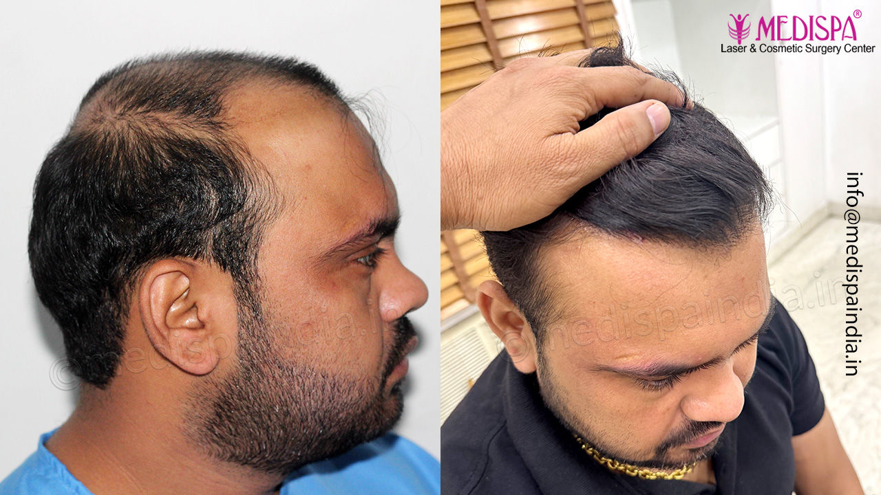 hair restoration faridabad