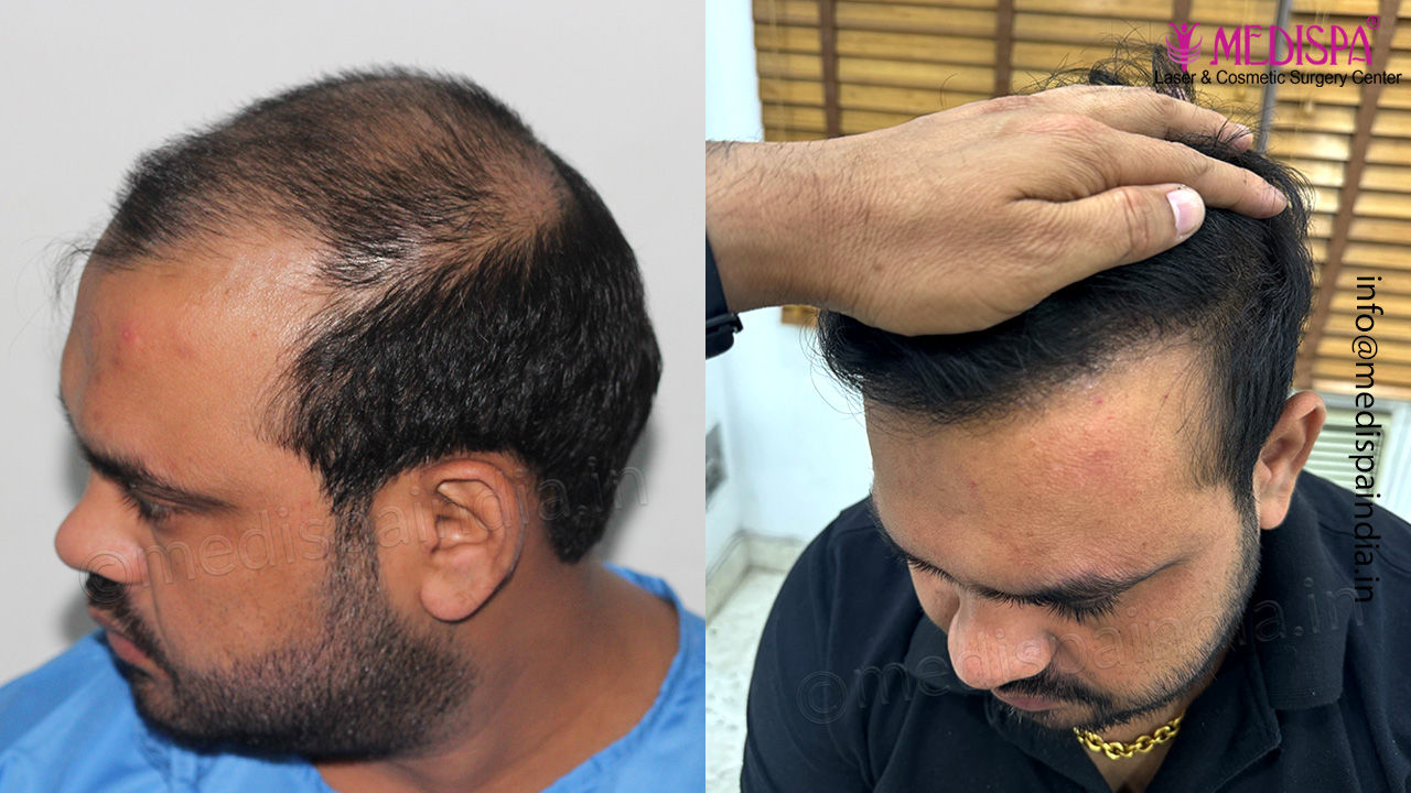 hair restoration gurgaon