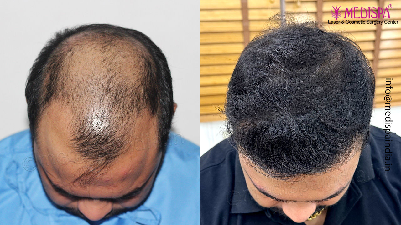 Hair Restoration Results Delhi