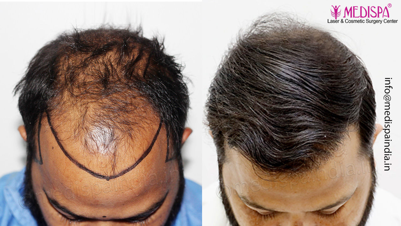 hair transplant delhi, india