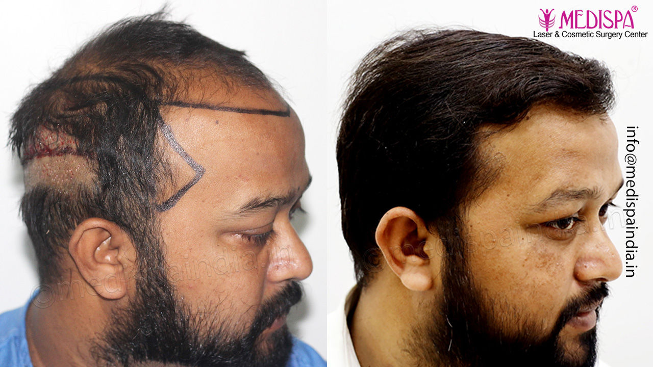hair restoration results gurgaon