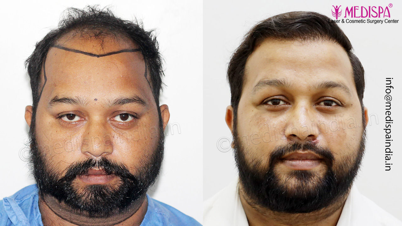 hair restoration results india