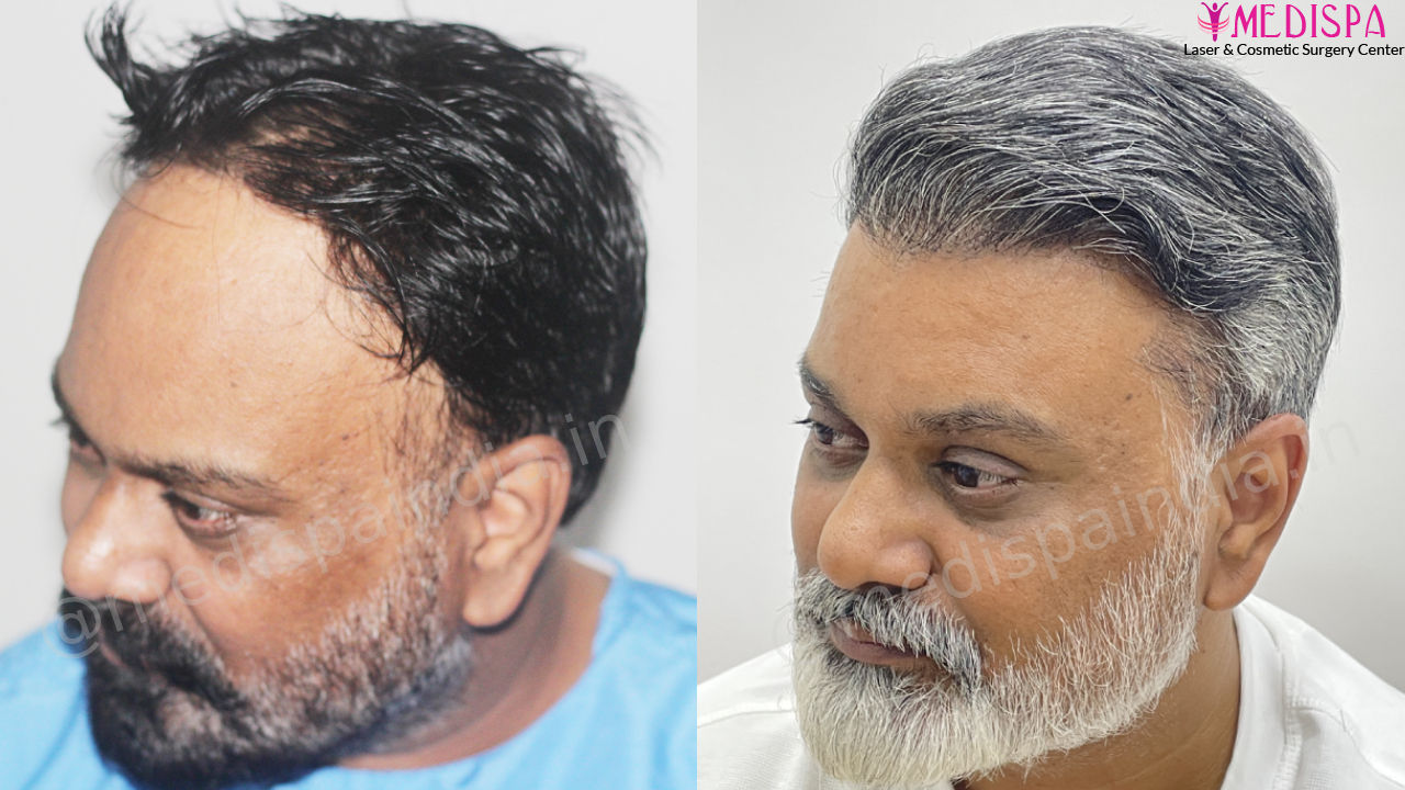 hair transplant clinic result