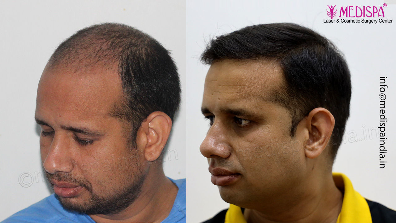 hair transplant india jaipur