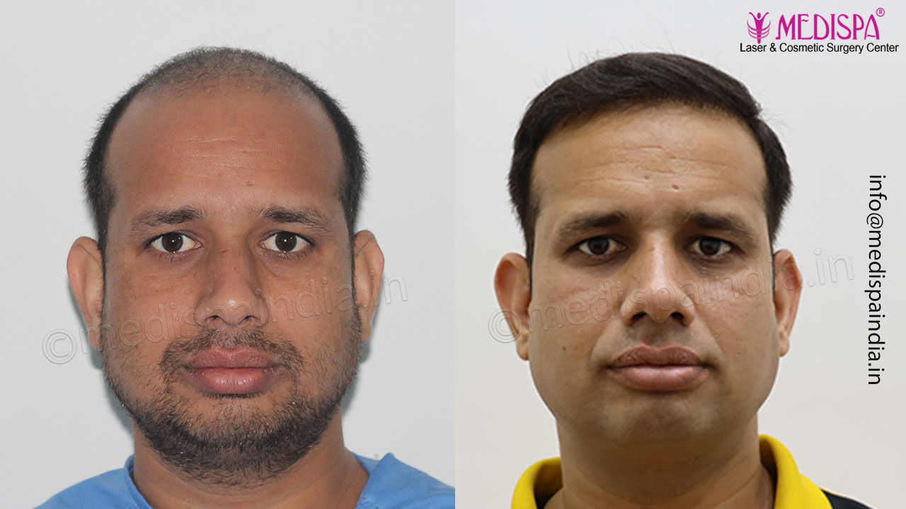 hair transplant india