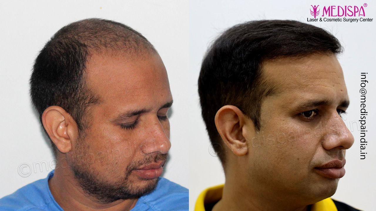 hair transplant results india