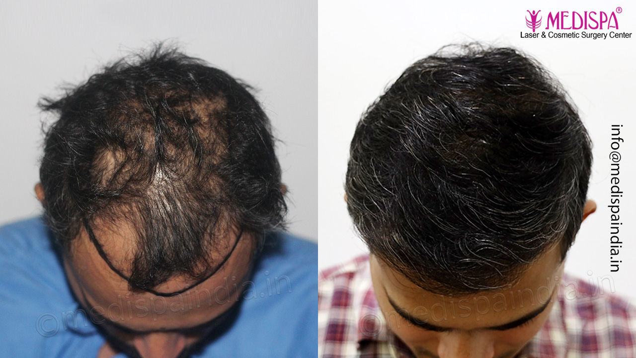 top hair transplant clinic result