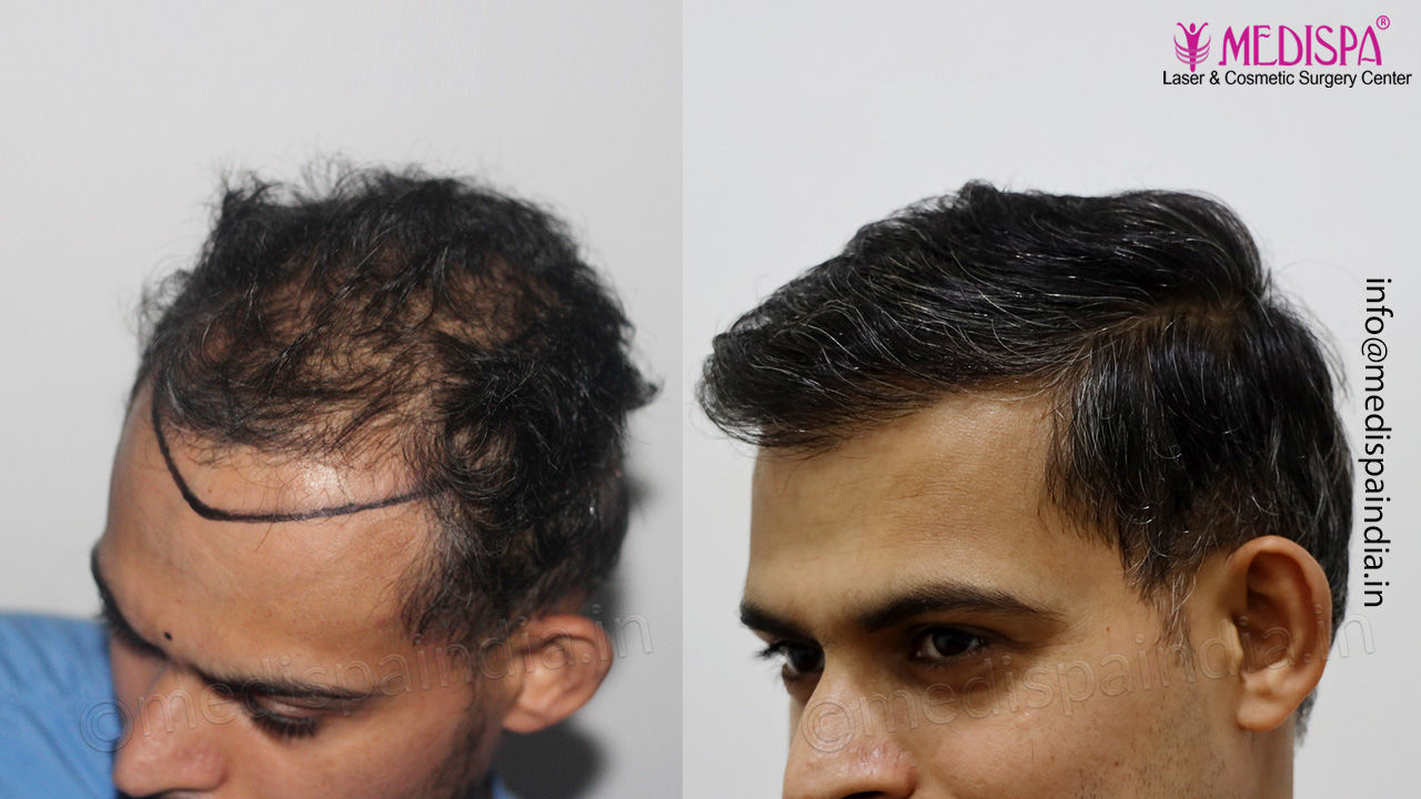 top hair transplant clinic results india