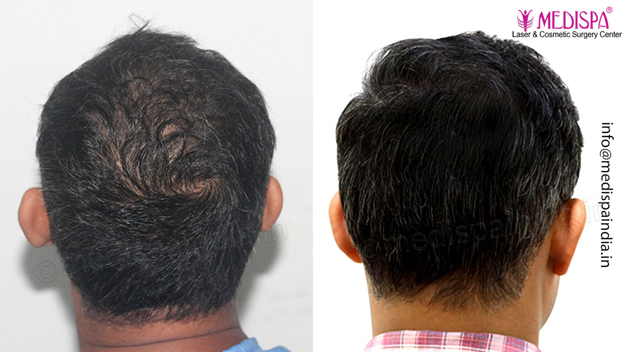 top hair transplant clinic results
