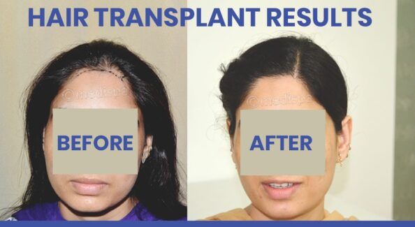 How To Get The Best Hair Transplant for Women?