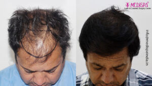 Best Hair Transplant in Delhi